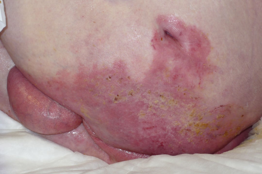 Decubitus